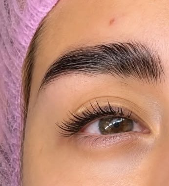 Resultado de lifting coreano, vista frontal